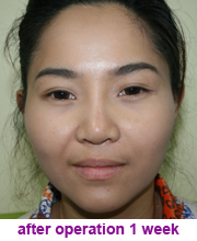 plastic_surgery_augmentation_rhinoplasty